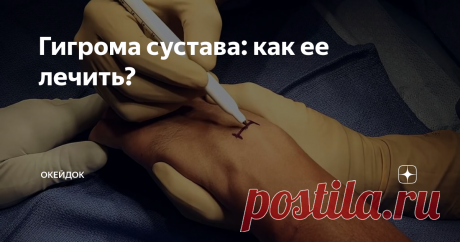 Гигрома сустава: как ее лечить? Многие сталкивались с такой проблемой, как небольшая шишка, например, на косточке запястья (или в каком-то другом месте), которая вдруг появляется, однако не болит, хотя и пугает. Непонятно: откуда она, что это, вообще, такое и что делать. Люди пытаются от шишечки избавиться «народными средствами» типа подорожника, чистотела или настойки из лопуха, но все без пользы. Потом они идут к врачу, и узна