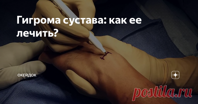 Гигрома сустава: как ее лечить? Многие сталкивались с такой проблемой, как небольшая шишка, например, на косточке запястья (или в каком-то другом месте), которая вдруг появляется, однако не болит, хотя и пугает. Непонятно: откуда она, что это, вообще, такое и что делать. Люди пытаются от шишечки избавиться «народными средствами» типа подорожника, чистотела или настойки из лопуха, но все без пользы. Потом они идут к врачу, и узна