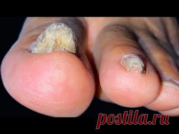 Устраняет грибок ногтей СРАЗУ! Лучшее средство! 2 отличных рецепта 🌿😍🔥