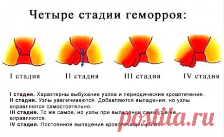 Симптомы геморроя у женщин описание фото