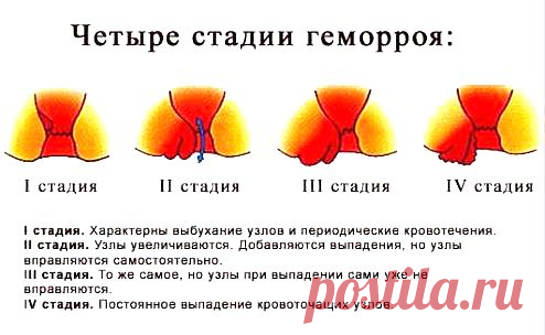 Симптомы геморроя у женщин описание фото
