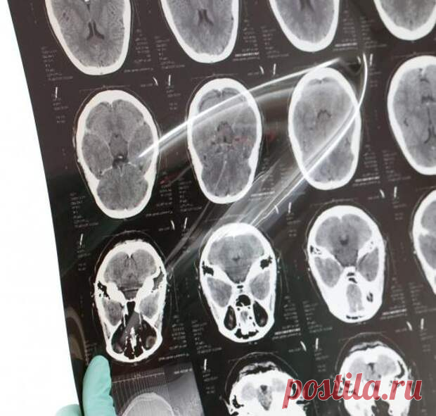 Признаки рака головного мозга: это важно знать каждому! - ПолонСил.ру - социальная сеть здоровья - Медиаплатформа МирТесен Рак головного мозга - это страшная болезнь, при котором внутри черепа начинают появляться различные новообразования. Клетки, являвшиеся ранее здоровыми частями тканей головного мозга, начинают вдруг бесконтрольно и стремительно делиться, образуя новообразования, существующих в организме - 19 августа - 43588546411 - Медиаплатформа МирТесен