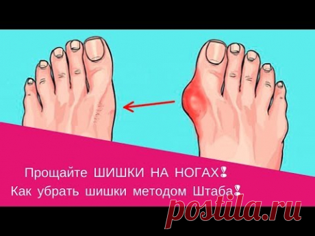 Прощайте ШИШКИ НА НОГАХ! Как убрать шишки методом Штаба!