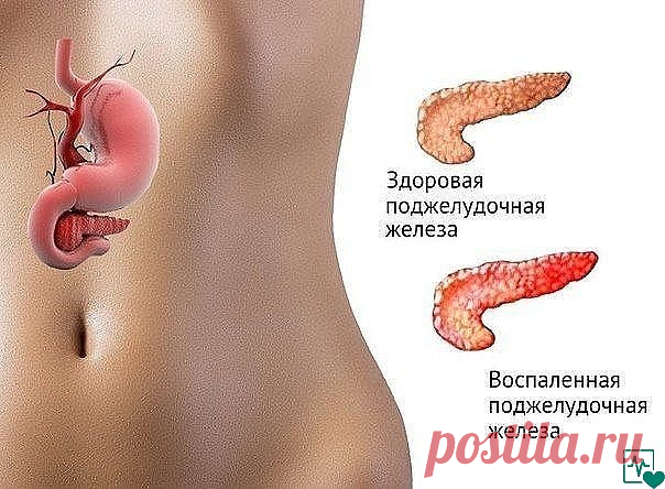 ЕСЛИ БЕСПОКОИТ ПОДЖЕЛУДОЧНАЯ ЖЕЛЕЗА 
Есть способ не только облегчить страдания, но и навсегда забыть о этой напасти..... Это семя льна..., оно единственное! способно вылечить вашу поджелудочную железу. 
 
Нужно: 
 
Свежемолотую столовую ложку семян льна заварить 0,5 стакана кипятка.... 
Дать потомиться на слабом огне 5 минут при закрытой крышке и оставить остывать в таком состоянии..... а тёпленьким, как остынет - выпить этот киселек вместе со всеми шелушками от семени за ...