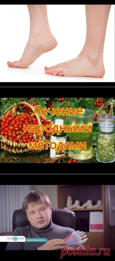 Пяточная шпора лечение в домашних условиях. Лечение пяточной шпоры желчью - YouTube