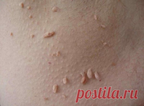 Народное лечение папилломы в домашних условиях.