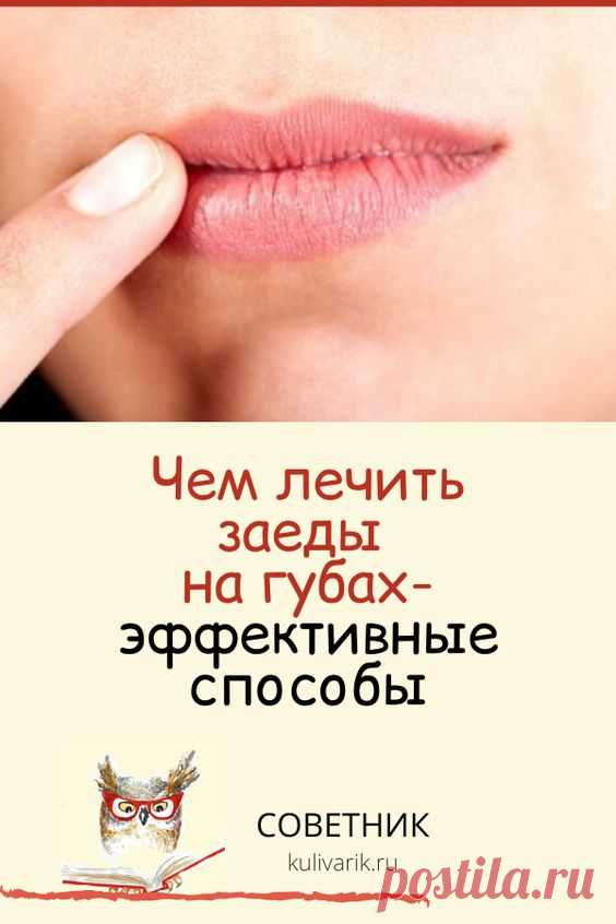 Чем лечить заеды на губах: эффективные способы