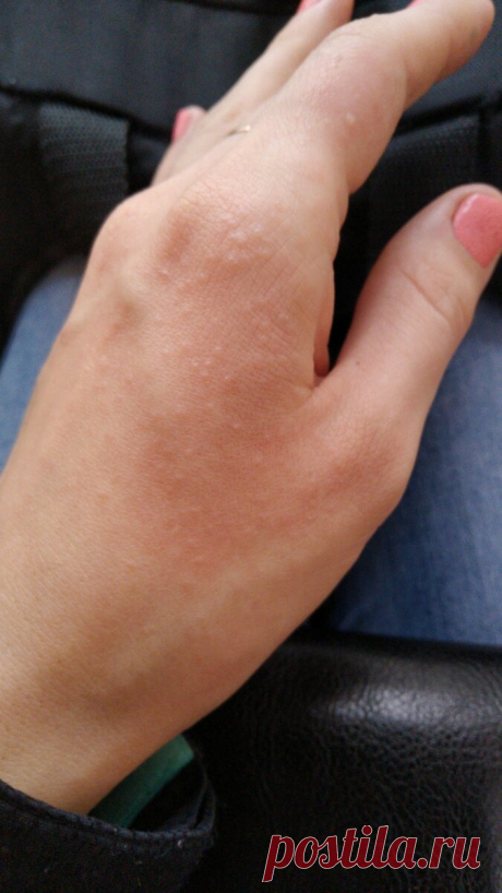 Обнаружен новый симптом поражения коронавирусом
Новый коронавирус – сложное испытание для человечества. Впервые заявив про себя каких-то три месяца назад в китайском городе Ухань, возбудитель стремительно распространяется по всей планете. Три месяца — еще небольшой срок, чтобы иметь абсолютное представление об этом инфекционном агенте, которого ранее наука не знала. Поэтому регулярно выявляют все новые и новые нюансы в течении болезни, […]
Читай дальше на сайте. Жми подробнее ➡