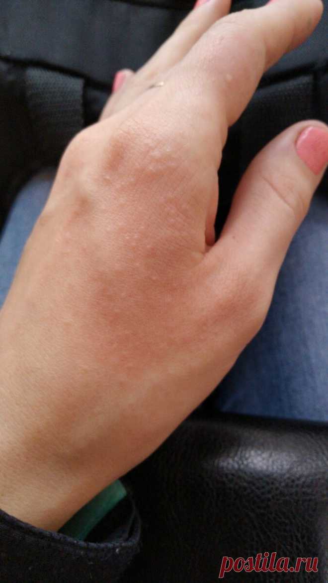 Обнаружен новый симптом поражения коронавирусом
Новый коронавирус – сложное испытание для человечества. Впервые заявив про себя каких-то три месяца назад в китайском городе Ухань, возбудитель стремительно распространяется по всей планете. Три месяца — еще небольшой срок, чтобы иметь абсолютное представление об этом инфекционном агенте, которого ранее наука не знала. Поэтому регулярно выявляют все новые и новые нюансы в течении болезни, […]
Читай дальше на сайте. Жми подробнее ➡