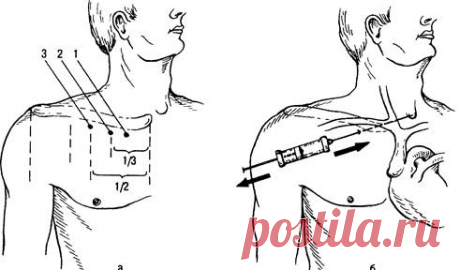 Пункция подключичной вены - Фото 27554-5
