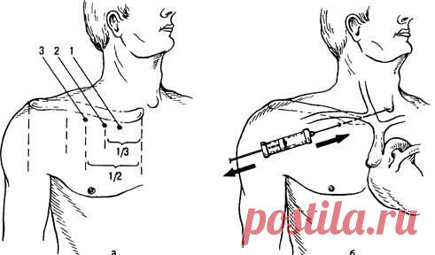 Пункция подключичной вены - Фото 27554-5