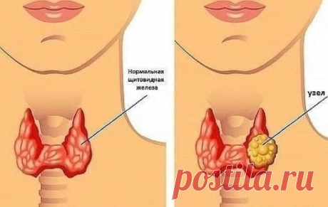Узловой зоб щитовидной железы — лечение по методу Евгения Петровича
Сулимова члена Ассоциации народных целителей Урала. 
У меня гостила сестра из России, которая оставила способ исцеления от
узлового зоба по рецепту Евгения Петровича Сулимова. Этот рецепт сестра
проверила на себе — результат положительный.
1. 1 стакан сухой или свежей травы чистотела высыпать в литровую банку,
залить 250 мл водки.
2. 50 г (аптечная упаковка) корня девясила и неполный стакан измельченной коры березы (не