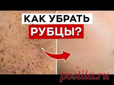 Как убрать шрамы от прыщей? / Как лечить постакне?