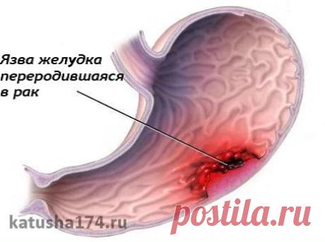 Лечение язвы желудка народными средствами. ✔ Вечером в термос засыпьте четыр...
