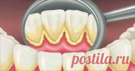 Как избавиться от зубного камня в домашних условиях | На каблуке | Яндекс Дзен