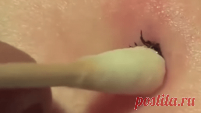 КАК УДАЛИТЬ КЛЕЩА В ДОМАШНИХ УСЛОВИЯХ: МЕТОД, КОТОРЫЙ СПАС ТЫСЯЧИ ЛЮДЕЙ!