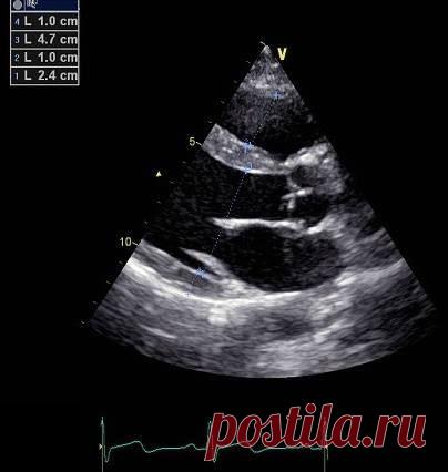 Эхокардиография для чайников, часть 1. Линейные измерения