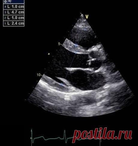 Эхокардиография для чайников, часть 1. Линейные измерения