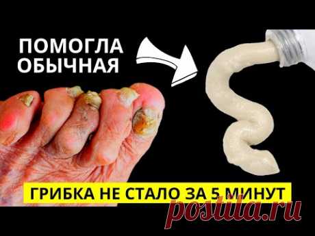 Эта Копеечная Мазь уберёт весь Грибок с ногтей ЗА 5 МИНУТ! Продается в любой Аптеке!