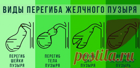У меня нашли загиб желчного пузыря: опасно ли это и чем это мне грозит | О здоровье: с медицинского на русский | Дзен