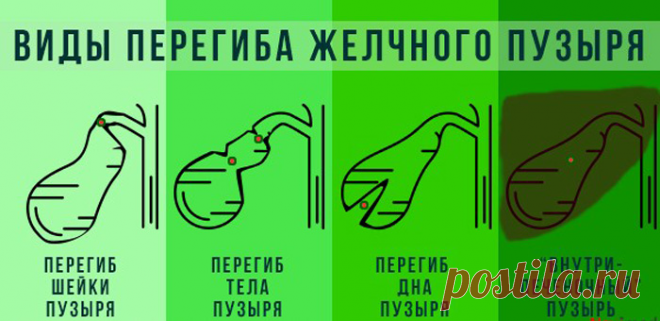У меня нашли загиб желчного пузыря: опасно ли это и чем это мне грозит | О здоровье: с медицинского на русский | Дзен