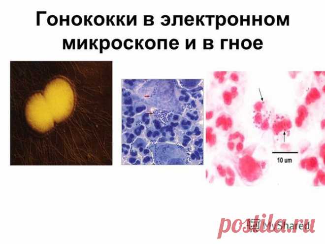 Лечим дома:гонококки
