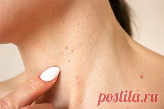 Как избавиться от папиллом? «Висюльки на коже» не красят. Как от них избавиться раз и навсегда?