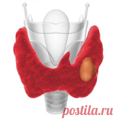 Узлы щитовидной железы. Причины, симптомы, признаки, диагностика и лечение патологии :: Polismed.com Округлые очаги разрастания ткани щитовидной железы - образования могут иметь капсулу, отделяющую их от окружающей ткани, или быть наполнены коллоидной жидкостью и 95% узлов доброкачественные и не несут опасности для жизни
