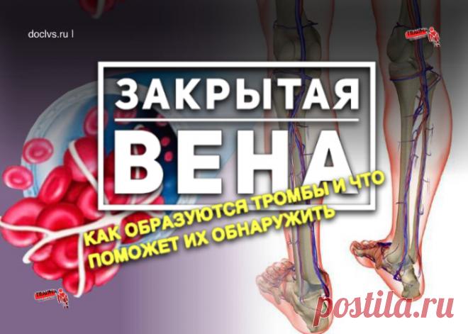 Если вена на голени вдруг стала плотной и болезненной или сильно опухла нога, необходимо срочно вызвать врача. Подобные симптомы могут указывать на тромбофлебит.