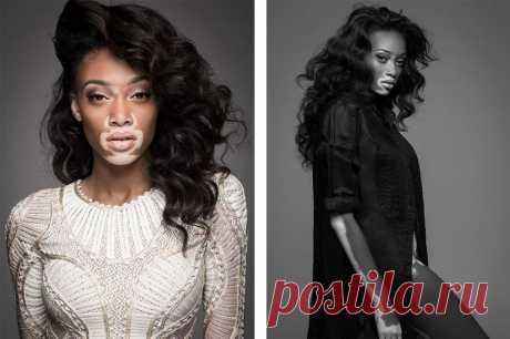 Почему появляются пигментные пятна и как от них избавиться