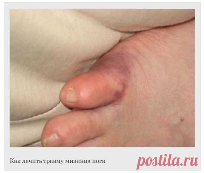 Ушиб мизинца на ноге. Здоровье