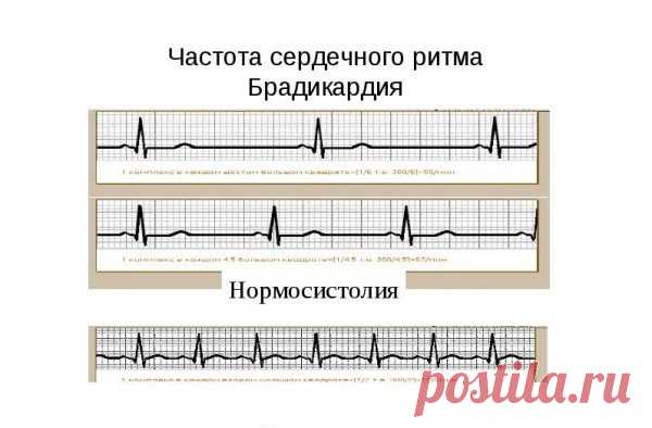 Брадикардия сердца – лечение народными средствами и правильное питание во время болезни