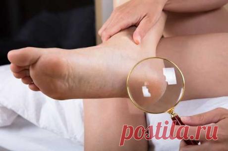 5 скрытых болезней, которые сопровождаются трещинами на пятках — СОВЕТНИК