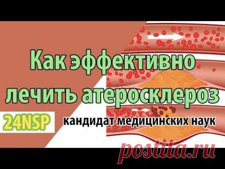 Как эффективно лечить атеросклероз сосудов? Атеросклероз - симптомы и причины! ✓ Лекция от к.м.н.
