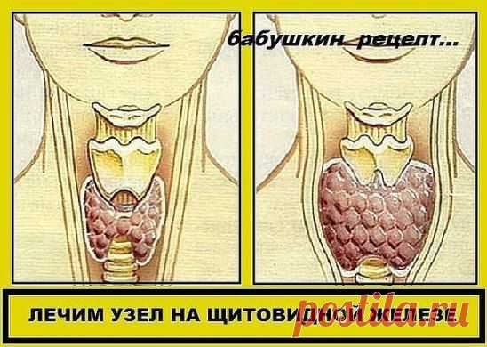 ЛЕЧИМ УЗЕЛ НА ЩИТОВИДНОЙ ЖЕЛЕЗЕ 
Один раз в неделю за целый день съешьте этот состав, не принимая больше никакой пищи, кроме воды.Сделайте так шесть раз, т. е. шесть недель.
Затем через месяц повторите лечение.Уже после первого курса зоб уменьшится, а после второго болезнь оставит вас.
Рецепт на сайте: http://nagotovka.moya-vkusnyatina.ru/lechim-uzel-na-shhitovidnoj-zheleze/
