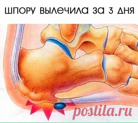 ШПОРУ ВЫЛЕЧИЛА ЗА 3 ДНЯ