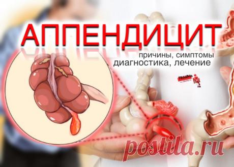 Аппендицит может возникнуть в любом возрасте и у людей любого пола. Однако статистика показывает, что чаще всего он воспаляется у людей в