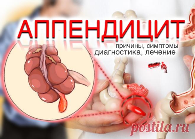 Аппендицит может возникнуть в любом возрасте и у людей любого пола. Однако статистика показывает, что чаще всего он воспаляется у людей в