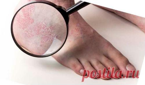 Ладонно-подошвенный псориаз, лечение, симптомы, формы, фото