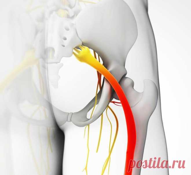 Защемление седалищного нерва: 5 способов облегчить боль Применение компрессов быстро снимает боль при защемлении седалищного нерва. Их действие обусловлено тем, что они расслабляют мускулатуру в пораженной зоне.