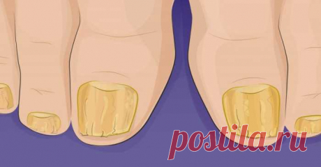 Моя бабушка еще знала об этом чудодейственном исцелении грибковых инфекций ногтей. Сегодня рецепт почти забыт. — Сад Заготовка