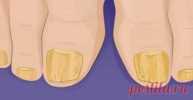 Моя бабушка еще знала об этом чудодейственном исцелении грибковых инфекций ногтей. Сегодня рецепт почти забыт. — Сад Заготовка