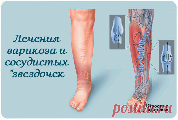 Несколько оригинальных народных рецептов лечения варикозного расширения вен и сосудистых "звездочек". | Женский журнал