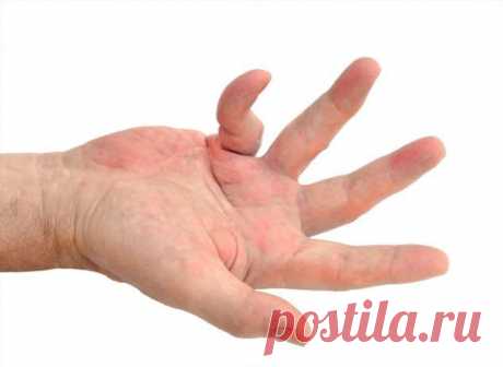 Контрактура Дюпюитрена | Краше Всех