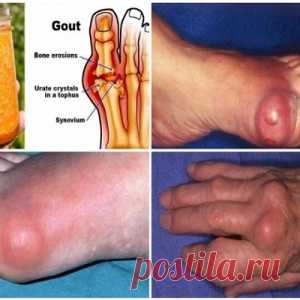 народное средство избавления от подагры