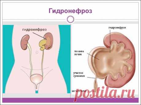 Гидронефроз