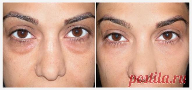 У вас мешки под глазами? Используйте пищевую соду, эффект НЕВЕРОЯТНЫЙ!