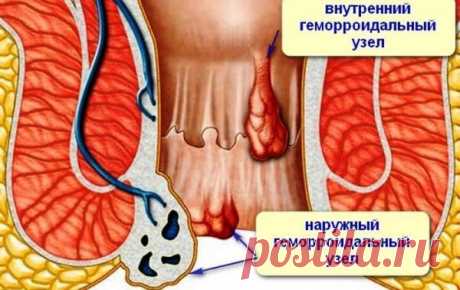 ЛЕЧЕНИЕ ГЕМОРРОЯ У ЖЕНЩИН БЫСТРО ДОМАШНИМИ СРЕДСТВАМИ