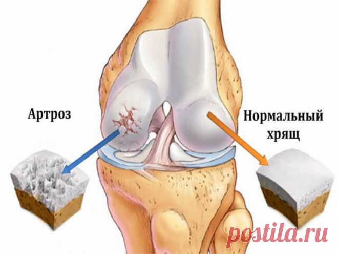 коксартроз и гонартроз разница - отличия и сходство симптомов Коксартроз и гонартроз-разница в симптоматике. Стадии развития двух заболеваний. Способы диагностики и лечения суставных патологий. Методы народной медицины