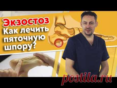 Почему болит пятка? | Экзостоз пяточной кости | Массаж при пяточной шпоре